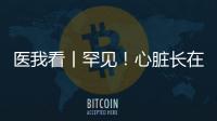 医我看丨罕见！心脏长在右胸膛！珠海成功开展首例“右位心”房颤射频消融术